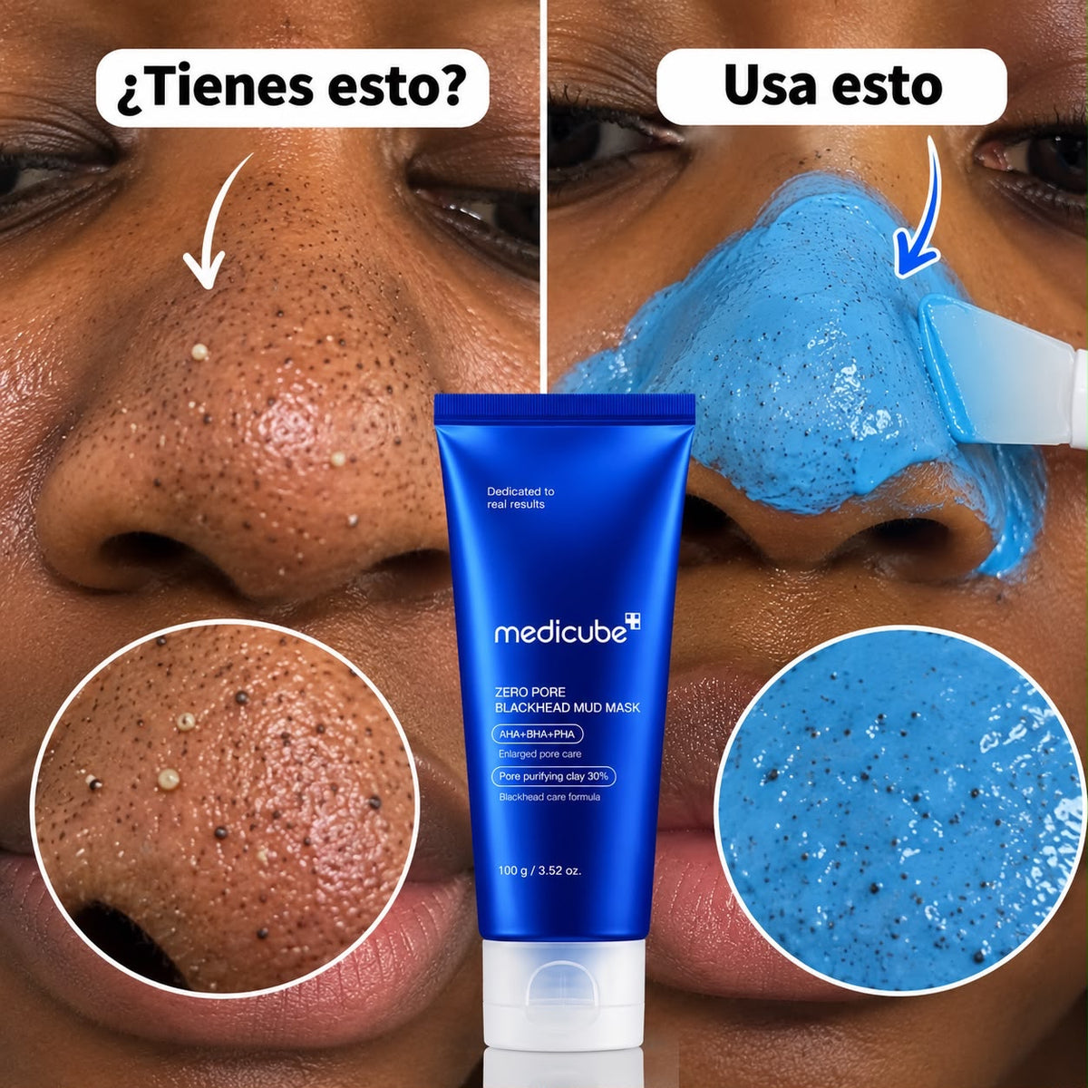 Medicube Zero Pore Blackhead Mud Mask aplicada en zona de poros y puntos negros